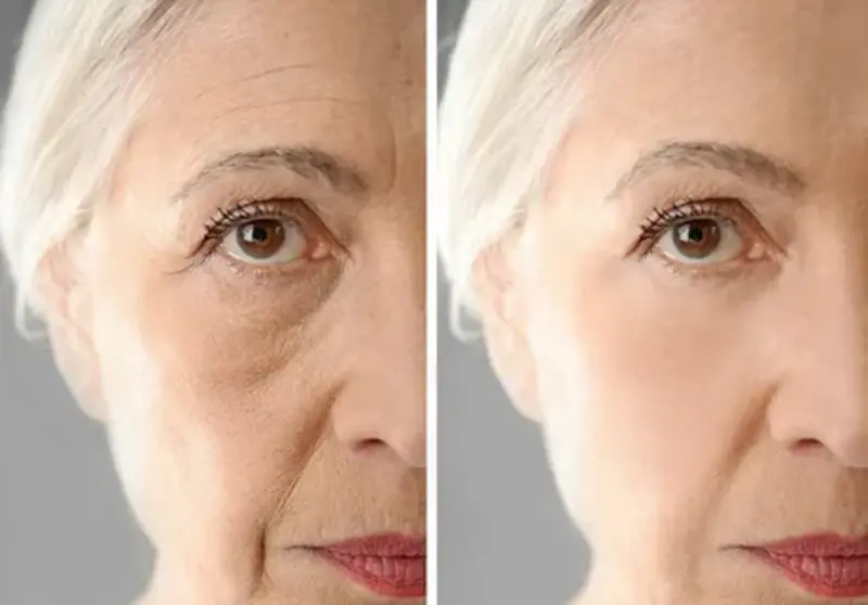 Rejuvenescimento a laser antes e depois